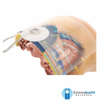 imagem Curativo para Tratamento por Pressão Negativa